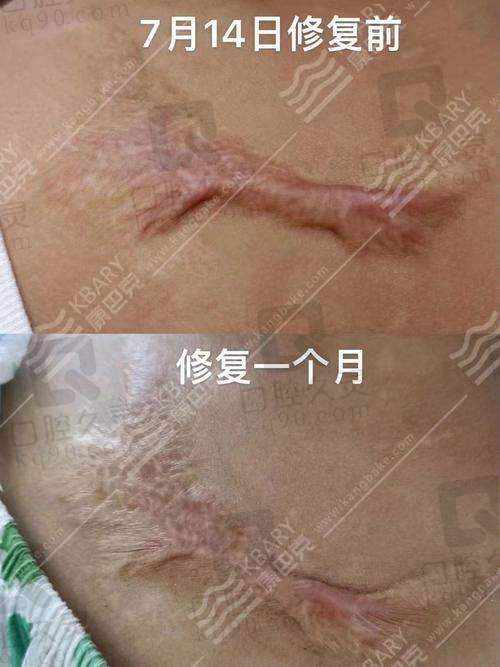 西宁韩美整形医院疤痕修复成效如何?