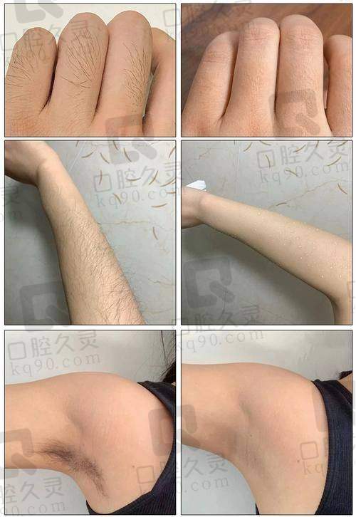 宝鸡晶肤医美激光脱毛180起，便宜有效果，毛发变少变细几分钟轻松搞定