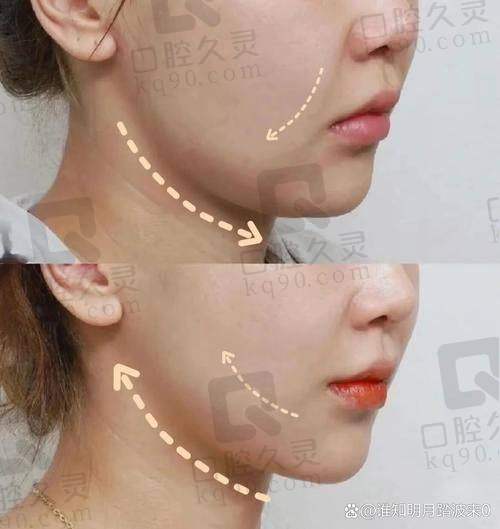 深圳瑞芙臣医疗美容射频提升体验：紧致肌肤效果显著，整个过程舒适又安心 