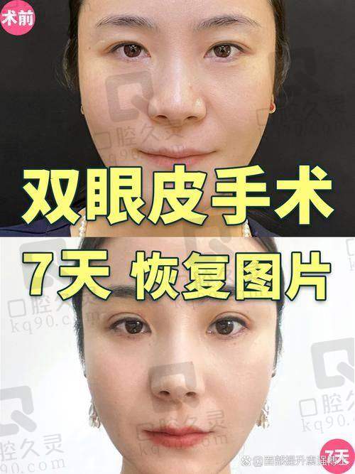 避雷3:动刀之前不了解现有眼部解剖状态