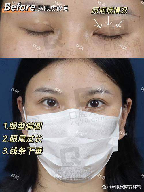 一文解答北京李燕双眼皮修复怎么样，技术优势、价格区间及适用人群全掌握！