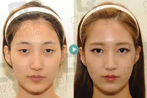 管果医生双眼皮手术价格贵不贵?性价比分析来了!