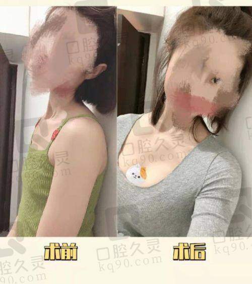 包涛医生隆胸技术的核心:双平面内窥镜+金字塔脂肪填充两手抓