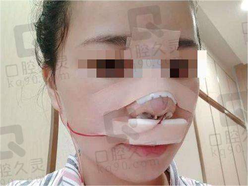 无锡施尔美整形医院鼻综合整形体验：重塑立体美鼻，术后效果自然，过程超安心 