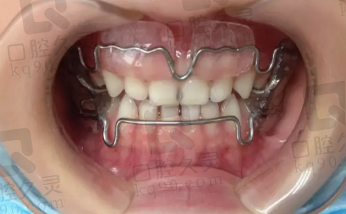 新乡植得口腔医院是正规医院吗?卫健委认证+20家连锁分院,种植牙2980元起可医保!