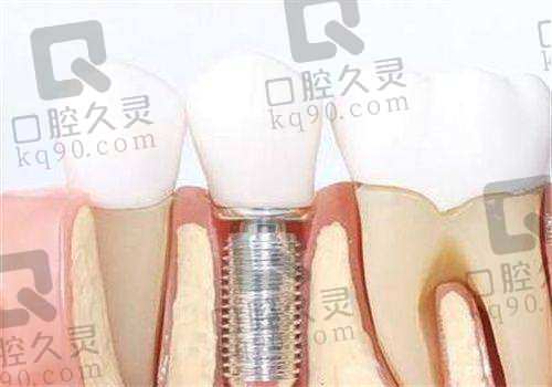 南宁岭南口腔种植牙价格表!揭秘亲民价,畅享高品质种牙体验焕新口腔健康