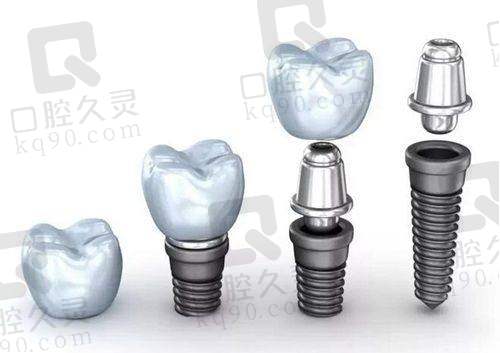 2、绵阳中绵口腔宋起医生种植牙怎么样?