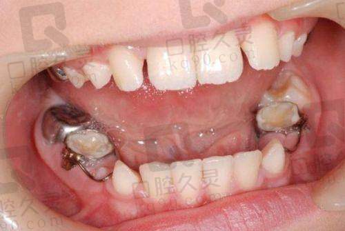 在新乡植得口腔医院,如何定制你的牙齿矫正方案?