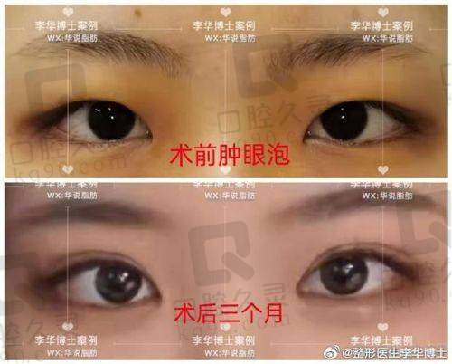 哪些人群特别适合找管果医生做双眼皮?