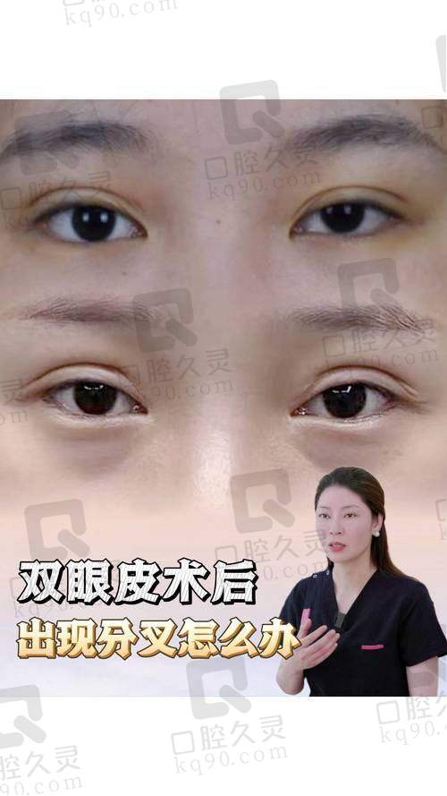 真实实例分享:术前术后大变样,双眼神采飞扬