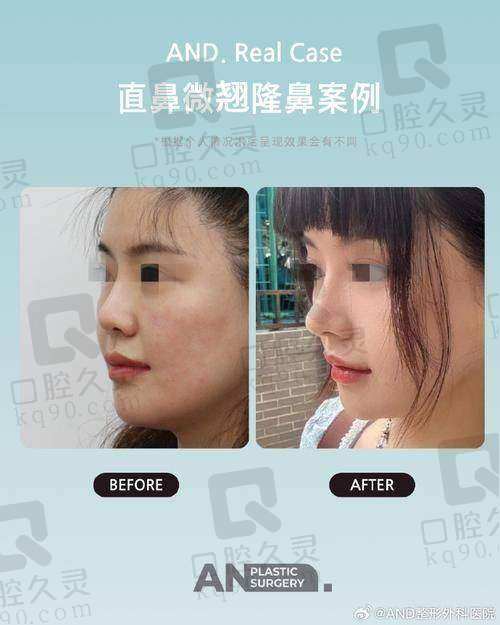 为什么选择无锡施尔美整形医院进行鼻综合整形?