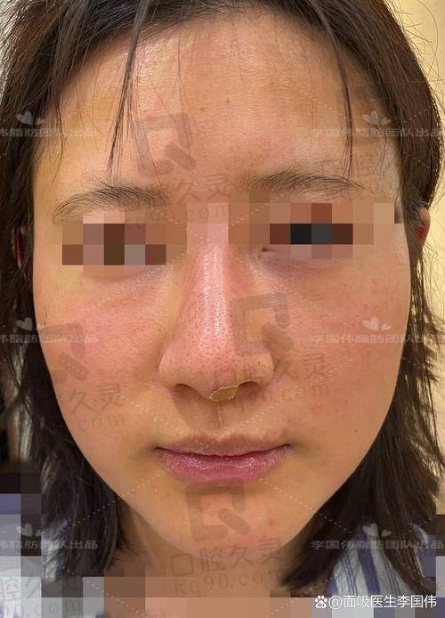 杭州时光项昌峰做鼻子术后实例曝光:真人术前术后对比图+真实反馈