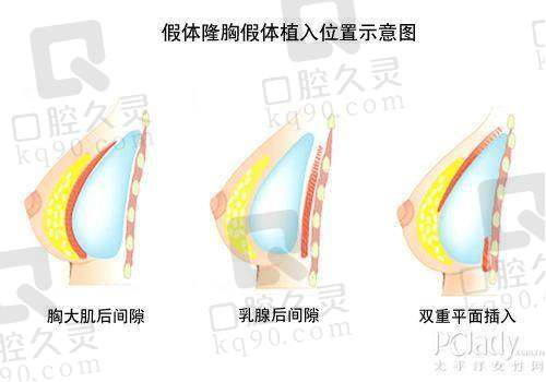 哪些人适合找梁耀婵做隆胸失败修复?