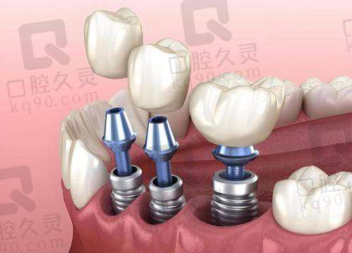上海鼎植医生周建亭种植牙实例