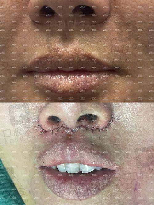 谭拯人中修复效果究竟如何?20年经验医生,低并发症高持久度优势显著