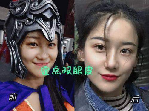 唐山煤医尚美王晓娟双眼皮术后成效