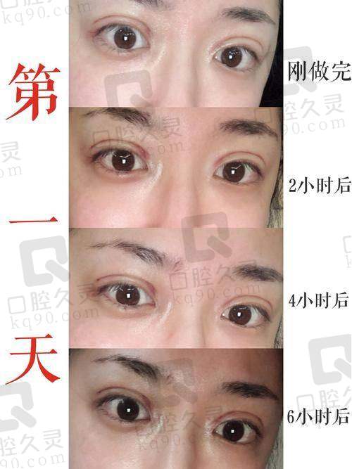 唐山煤医尚美王晓娟双眼皮价格多少？3800 元起埋线术，微创速愈打造自然美眼