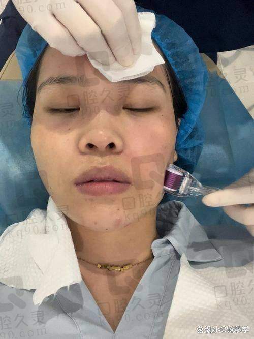 除皱针的成效如何?