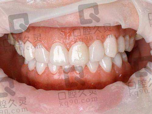 打卡吉安仁心口腔医院牙贴面美白，牙齿焕亮超自然，自信笑容轻松拥有！ 