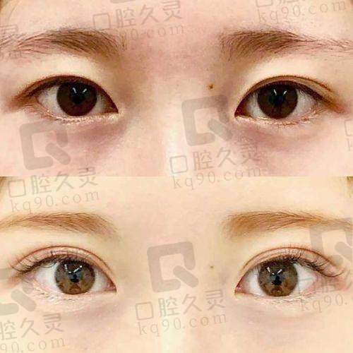 佳木斯韩艺来做双眼皮好么?专业技术、优质服务成就自然灵动美眼效果